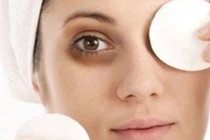 Những điều chưa biết về bệnh thâm quầng mắt