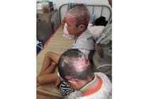 Hai anh em ruột quằn quại vì mắc bệnh da cánh bướm