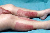 Hôn mê, chân hoại tử vì cạo lông vùng kín