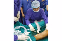 Dùng laser nội mạch điều trị giãn tĩnh mạch