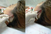 Hoại tử vành tai, mất da đầu khi hấp tóc đón Tết 