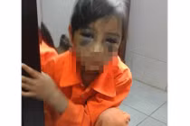 Tin mới vụ bé gái bị đánh tím mắt vì viết chính tả chậm