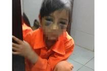 Tin mới vụ bé gái bị đánh tím mắt vì viết chính tả chậm