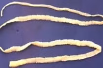 Kinh khủng sán xơ mít 10 mét làm ổ trong người