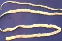 Kinh khủng sán xơ mít 10 mét làm ổ trong người