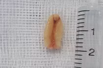 Tưởng con viêm phế quản, không ngờ hạt lạc nằm trong đường thở 