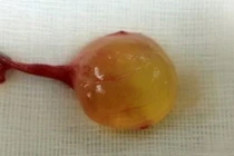 Tá hỏa vì con trai bỗng dưng có 3 tinh hoàn 