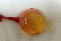 Tá hỏa vì con trai bỗng dưng có 3 tinh hoàn 