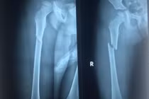 Cha dượng đánh bé trai 5 tuổi gãy chân ở Sài Gòn