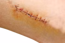 Chuyện hy hữu: Dùng chỉ may quần áo khâu… vết thương