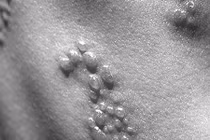 Méo miệng, nhiễm trùng vì đắp đậu xanh chữa zona thần kinh