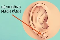 13 dấu hiệu bệnh tật ngỡ là điều bình thường