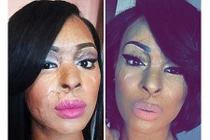 Nỗi đau tạt axit bạn thân chỉ vì đố kỵ