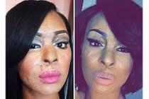 Nỗi đau tạt axit bạn thân chỉ vì đố kỵ