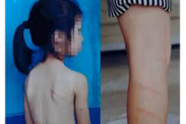 Nghệ An: Học sinh lớp 1 không làm được bài tố bị cô giáo đánh