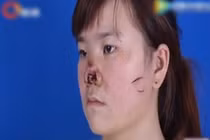 Kinh hoàng thiếu nữ cưới chui, bị chồng cắn nát mũi