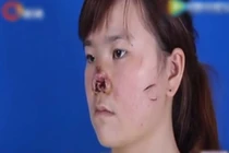 Kinh hoàng thiếu nữ cưới chui, bị chồng cắn nát mũi