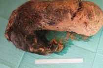 Kinh ngạc lấy búi tóc nặng 1,3 kg trong bụng cô gái 