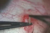 Ghê sợ hình ảnh bác sĩ gắp con giun sống 2 năm trong mắt người