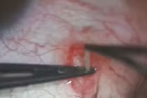 Ghê sợ hình ảnh bác sĩ gắp con giun sống 2 năm trong mắt người