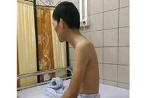 Phẫu thuật chỉnh hình cho bệnh nhân gù nặng