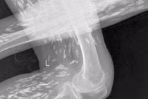 Kinh dị sán “dạo chơi” trong cơ thể vì ăn tiết canh 