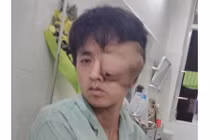 Người đàn ông mắt lòi ra khỏi tròng vì khối u khổng lồ