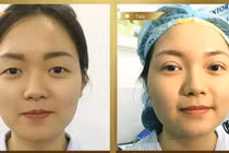 Hô biến mắt 2 mí rõ nét bằng hai phương pháp cắt mí và bấm mí