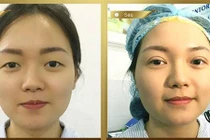 Hô biến mắt 2 mí rõ nét bằng hai phương pháp cắt mí và bấm mí