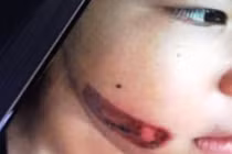 CA điều tra nghi vấn bé 7 tuổi bị cha ruột và mẹ kế bạo hành, dí sắt nung đỏ vào mặt