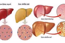 Chuyên gia khuyến cáo 10 điều cần làm khi bị gan nhiễm mỡ