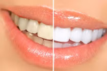 5 bí quyết để có một hàm răng trắng sáng rạng ngời