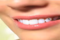 Cận cảnh quy trình gắn đá lên răng