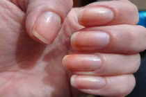 7 dấu hiệu bất thường ở móng tay cảnh báo bệnh nguy hiểm