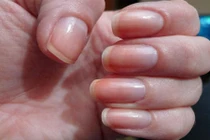 7 dấu hiệu bất thường ở móng tay cảnh báo bệnh nguy hiểm