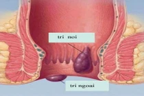Với bài thuốc này, trĩ nội, trị ngoại đều khỏi hết