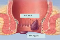 Với bài thuốc này, trĩ nội, trị ngoại đều khỏi hết