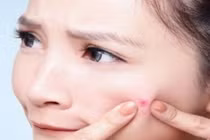 Sự hình thành mụn và cách chữa mụn khoa học nhất