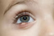 5 cách tự chữa lẹo mắt tại nhà ít người biết