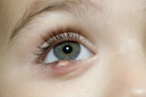 5 cách tự chữa lẹo mắt tại nhà ít người biết