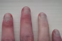 Cách phát hiện bệnh tật qua móng tay nhanh nhất