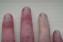 Cách phát hiện bệnh tật qua móng tay nhanh nhất