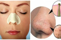 Cách làm keo lột mụn đầu đen cực hiệu quả ngay tại nhà