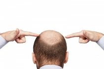 Bí quyết đơn giản ngăn rụng tóc tuyệt vời cho phái mạnh