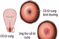 Các loại ung thư cổ tử cung phổ biến