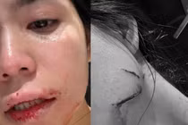 Hằng Du Mục tung hình ảnh đầy vết thương khi bị chồng bạo hành