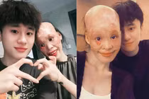 Sự thật chuyện cô gái bỏng toàn mặt do cứu mẹ bạn trai 