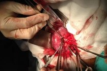 Những tai biến có thể xảy ra khi mổ sỏi thận