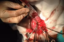 Những tai biến có thể xảy ra khi mổ sỏi thận