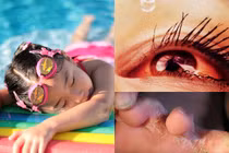 10 bệnh bé yêu dễ mắc khi đi bơi mùa hè